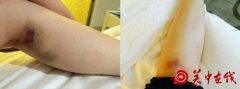 张含韵爆双腿淤青照 转型打女＂打上瘾＂
